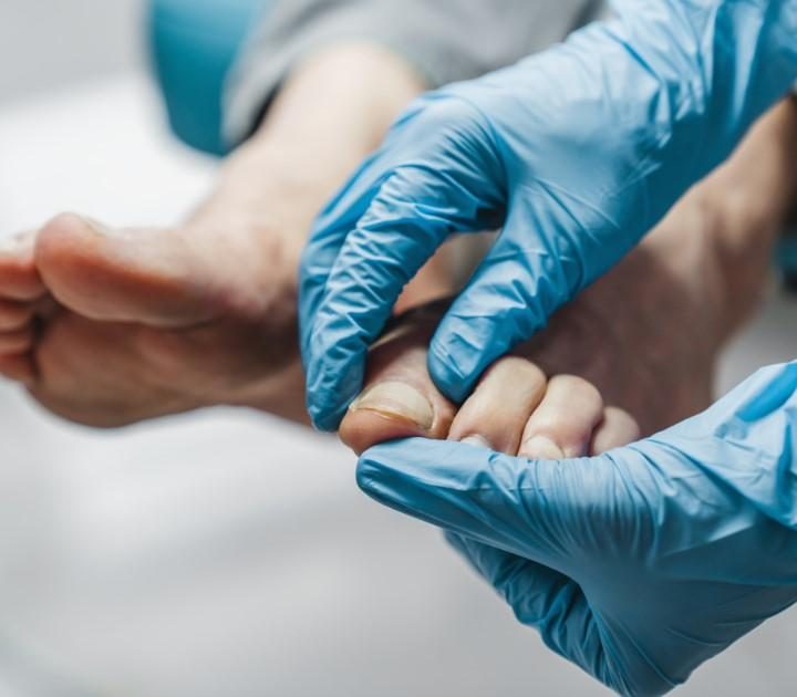 Hammertoe condition affecting the alignment of the toes